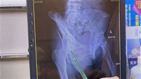 高雄,跌倒,鋼絲,穿刺