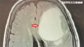 有一顆約8公分大的腫瘤在左側大腦額葉處，壓迫腦神經
（圖／台北慈院提供）
