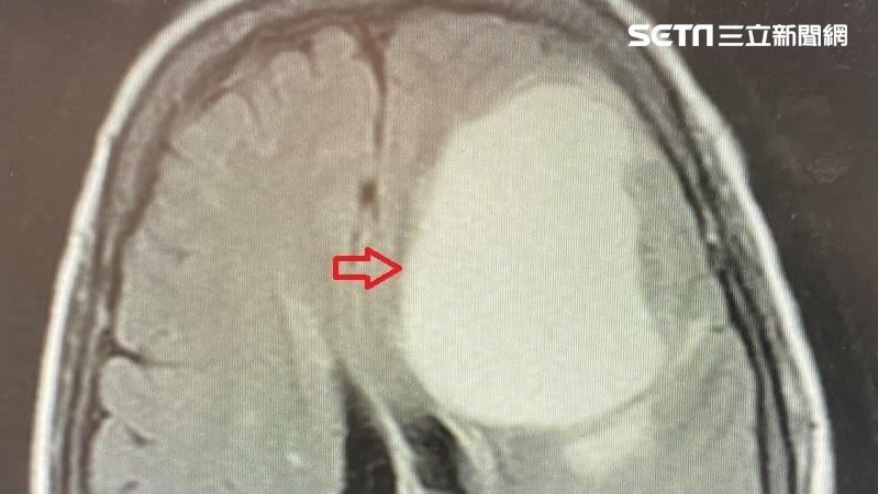 以為中風　竟乳癌轉移腦長8公分腫瘤