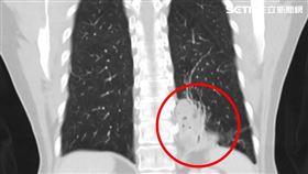 六旬女性咳血逾十年，竟是胃的一條血管進到肺臟惹的禍。台中慈濟醫院胸腔外科醫師柯志霖診斷出「極為罕見的肺內游離肺」，才知道怎麼治都治不好的原因。（圖／台中慈濟醫院提供）

