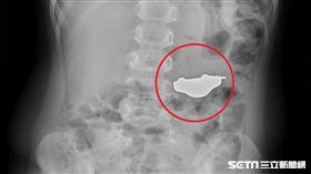5歲童吞玩具車／中國附設兒童醫院提供