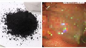 老翁X光片(圖/翻攝畫面)
