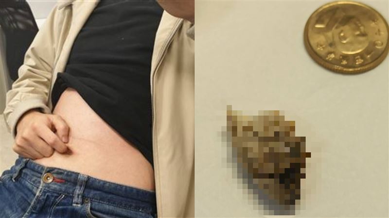 他肚臍流汁發臭　一挖陳年巨屎滾出