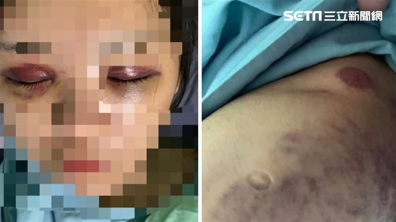 台中恐怖家暴　正妹全身傷慘成熊貓眼