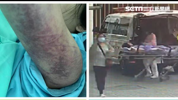 台中正妹遭渣男痛毆　傷勢連醫都吃驚