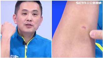 藍委衝立院皮開肉綻　一看傷口尷尬了