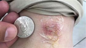 民進黨籍立委郭國文則在臉書秀出自己的受傷照
（圖／翻攝自郭國文臉書）

