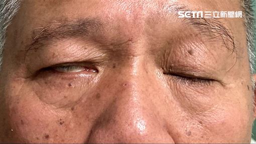 皮蛇纏身錯過72小時黃金期65歲男視力受損 右臉僵硬 健康 三立新聞網setn Com