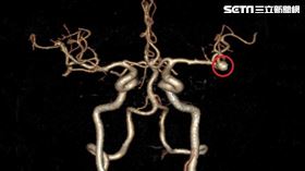 開顱手術,電腦斷層,大腦動脈瘤,台北慈濟醫院,神經外科,徐賢達（圖／台北慈院提供）