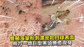 雙頰海量粉刺濃密如月球表面　用力一擠巨型黑頭療癒現