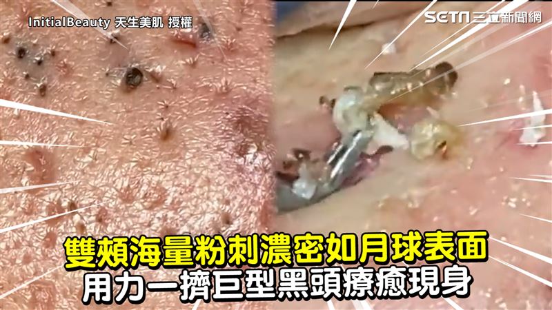 雙頰海量粉刺濃密　一擠巨型黑頭現身