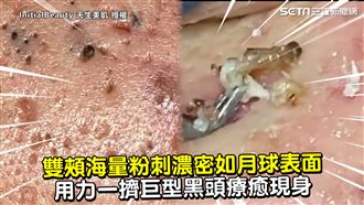 雙頰海量粉刺濃密　一擠巨型黑頭現身