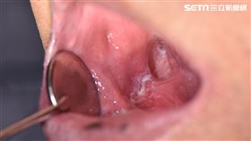 右側後臼齒區口腔癌，白斑清楚可見（圖／安南醫院提供）