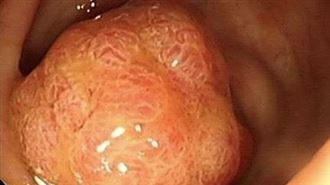 每35分1人大腸癌!專家:少喝果汁