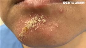 女騎車回家下巴竟爛掉！全因她在路上遭0.5公分小蟲偷襲