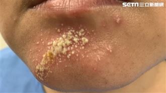 0.5公分小蟲偷襲 女騎車下巴竟爛