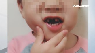 2歲童牙被扳斷　母控幼兒園隱瞞真相