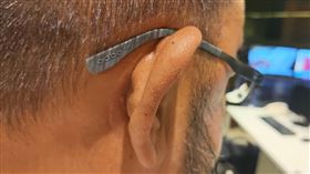 ▲耳上有痣。（示意圖／三立新聞網）