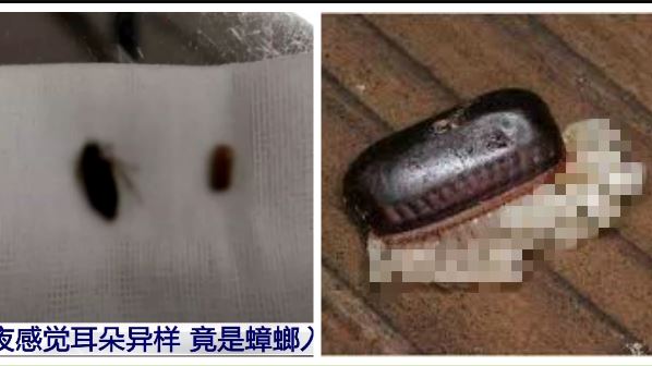 癢炸！驚見耳內「咖啡色彈匣」全孵化