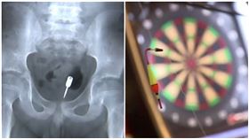 9歲男童貪玩「飛鏢塞肛門」　直腸這塊屎救了他（圖／翻攝自看看新聞、資料照）