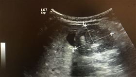 還好媽媽夠機警！男童間歇哭鬧原來腸子卡住　醫：拖延會死（圖／翻攝自花蓮慈濟醫院臉書）