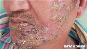 「皮蛇」／帶狀皰疹（南投醫院提供）