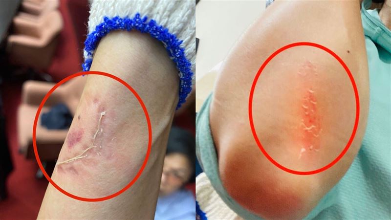 PO出藍委咬傷照…林楚茵：醫院驗傷
