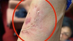 林楚茵PO出「被國民黨委員咬傷」照（圖／翻攝臉書）