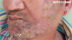 男得皮蛇／南投醫院提供