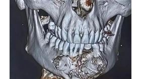 達倫下顎長出拳頭般大小的腫瘤。（圖／翻攝自Darren Wilkinson臉書）