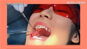 嘴遭撐大放入鐵絲　正妹公開戴牙套