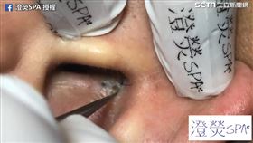 耳內超深3洞黑頭粉刺。（圖／澄熒SPA臉書授權）