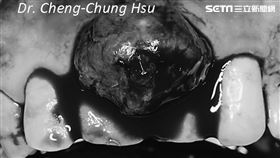 牙齦腫大地方不僅沒消退，範圍還愈來愈大，形成一團類似肉瘤東西（圖／安南醫院提供）