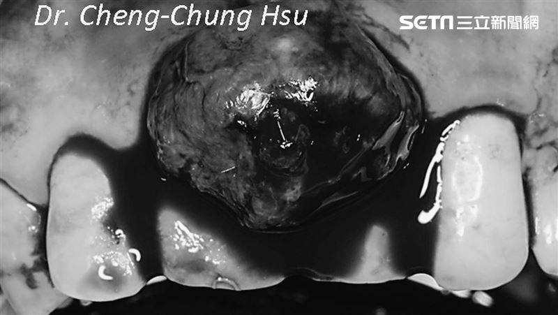 女牙齦腫大沒就醫　結果長出一團肉瘤