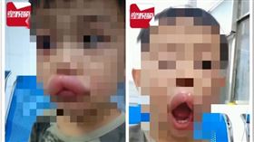 中國,廣西,男童,葡萄,葡萄乾,過敏,嘴唇（圖／翻攝自微博）