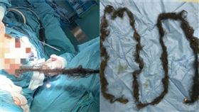 46歲女懷畸胎瘤！醫拉出「200公分頭髮」嚇：第一次見▲。（圖／翻攝自廣州日報微博）