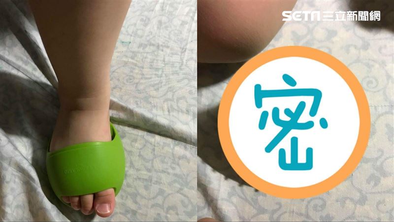女兒「拖鞋」長危險顆粒　媽一看驚呆