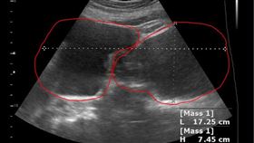 大水瘤（南投醫院提供）