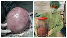 子宮肌瘤（愛麗生婦產科院長潘俊亨）