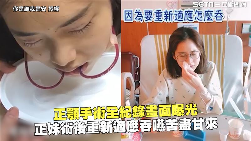 正顎手術畫面曝　她術後重新適應吞嚥