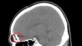 高雄市，釘子，張書瀚，醫師，額葉區，腦幹