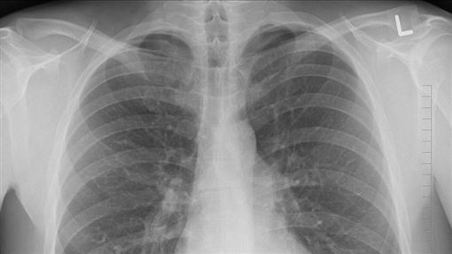 不菸不酒罹肺腺癌！手指2異狀成關鍵線索