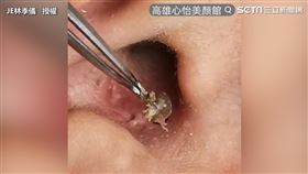 陳年大魔王2洞相連超頑固　耳內巨型黑頭一拉出嚇屎人