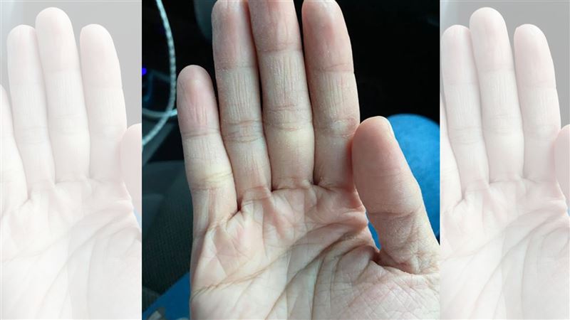 天使的手！護理師雙手慘況逼哭網友