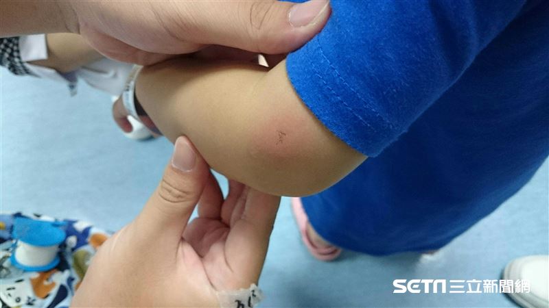2歲女高燒長紅斑　竟是兒童致命罕病