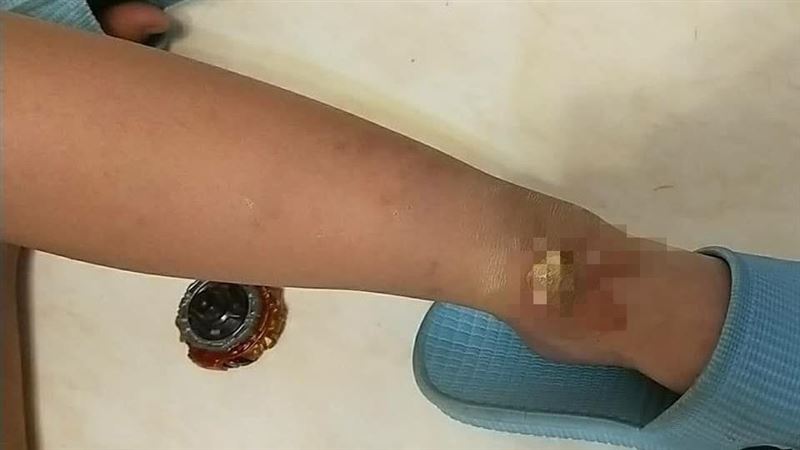 小1童被燙傷沒掉一滴淚…原因惹心疼