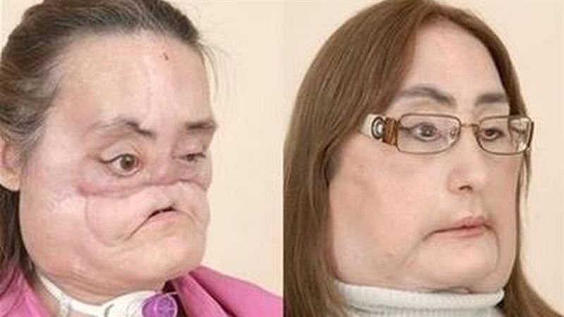 遭夫槍擊毀容　美國首臉部移植者逝世