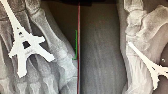 痛！赤腳誤踩鐵塔模型　整根鑽入腳掌