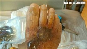 急診醫師照會感染科洪伯斌主任，診斷為海洋弧菌感染，已侵犯至皮膚深部，造成壞死性筋膜炎（圖／台北慈院提供）