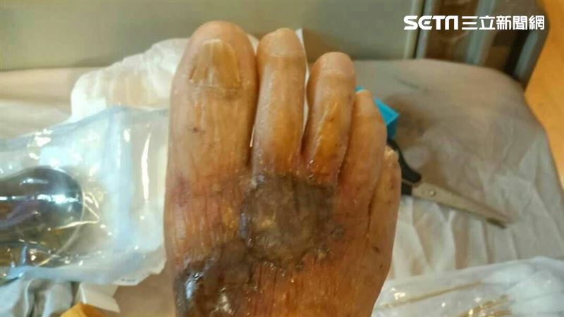 海邊踢到石頭破皮　男竟壞死性筋膜炎